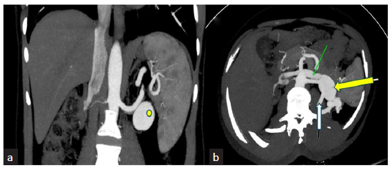 Contrast CT abdomen (a) (coronal) and (b) (axial) images of arterial phase CT of abdomen showing a saccular contrast filled outpouching (yellow dot/arrow) arising from the left renal artery with drainage into left renal vein (green arrow in b). Also seen is the left renal arteriovenous fistula (white arrow in b).