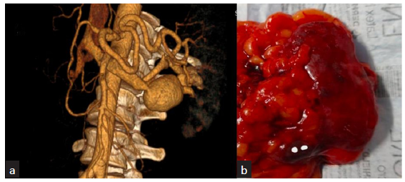 (a) 3D Reconstructed Angiographic image showing large aneurysmal sac draining in to left main renal vein. (b) Post Nephrectomy specimen showing left kidney with lower pole aneurysmal sac due to arteriovenous fistula.