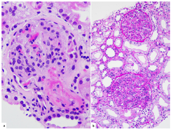 Renal biopsy of patient 1. (a) Fibrin thrombus occludes the afferent arteriole and some of the capillary lumen. There is endocapillary hypercellularity and neutrophilic infiltration in the capillary tuft (H&E, ´400). (b) The glomeruli show diffuse and global endocapillary hypercellularity, consistent with IRGN (PAS ´100). IRGN: Infection-related glomerulonephritis, H&E: Hematoxylin and eosin, PAS: Periodic acid-Schiff.