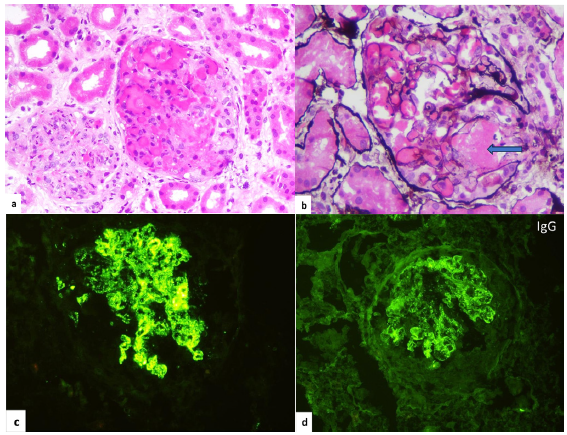 Renal biopsy of patient 2. The glomerulus on the right shows dilated and congested capillaries with fibrin thrombus in some segments. (a) The glomerulus on the left displays endocapillary hypercellularity and neutrophilic influx (H&E ´200). (b) Fibrin indicated by blue arrow, occludes the afferent arteriole (Jones silver, ´400). (c and d) Immunofluorescence study demonstrates granular deposits of C3 (+3) and IgG (+2), respectively, on the glomerular capillary loops and mesangium, H&E: hematoxylin and eosin.