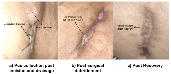 (a-c) Stages of surgical wound healing in a case of mycobacterial infection.