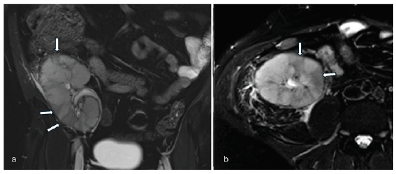 A T2 weighted MRI images of the transplant kidney. (a) Coronal and (b) axial images shows multifocal, wedge-shaped areas of T2 hypointensities (white arrows) suggestive of cortical infarcts. MRI: magnetic resonance imaging.