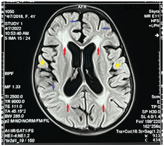 Magnetic resonance imaging of the brain showing confluent areas of FLAIR hyperintensities in periventricular white matter, in particular around the posterior periventricular area and frontal horns (red arrows) with sparing of subcortical U-fibers (blue arrows) with mild brain atrophy (yellow stars), AFR: apparent focal restriction.