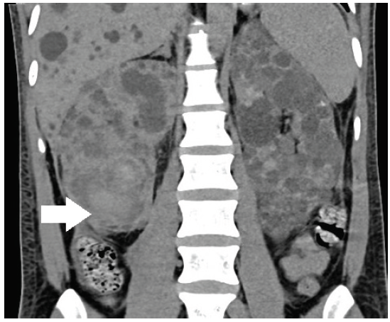 Contrast CT of kidneys. Bilateral enlarged polycystic kidneys and liver. The hyperdense regions involving right lower pole (white arrow) indicate hemorrhagic cysts. CT: Computerized tomography.