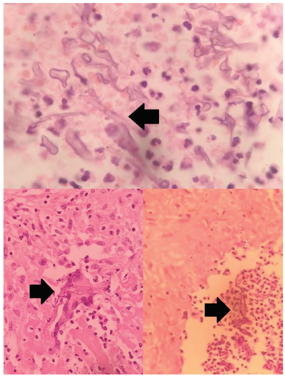 Histopathology of right nephrectomy specimen. Broad aseptate hyphae with branching at right angle (black arrows) are consistent with mucormycosis.