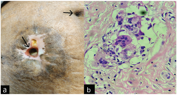 (a) Catheter tunnel exit site (black arrows), (b) Histology showing foreign body granuloma.