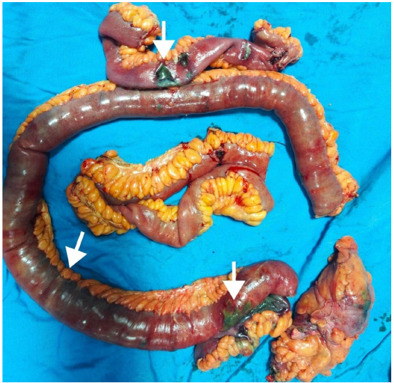 Resected small bowel segment showing gangrenous patches (marked by arrow heads) with intervening normal segments.