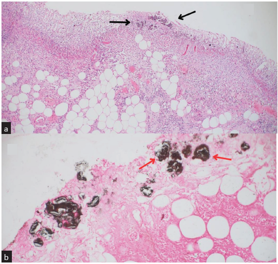 (a) Shows complete loss of intestinal mucosa with ischemic necrosis. It also shows basophilic masses of calcification (bold black arrows) in the muscular mucosae and the lamina propria suspicious of calcium deposition (Stain—Eosin and hematoxylin at 200× magnification). (b) Von Kossa stain highlights the calcium deposits in the vessels by taking up the black color (bold red arrows). It also shows thrombosis within the serosal vessels, confirming the metastatic calcification leading to mucosal ischemia (400× magnification).