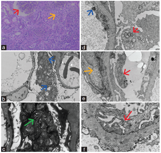 Kidney biopsy of Case 1: (a) Shows non-proliferative glomeruli (red arrow), focal chronic tubulointerstitial nephritis (yellow arrow), and interstitial fibrosis and tubular atrophy of cortex (40×, PAS, light microscopy), (b) Show enlarged visceral epithelial cells containing many osmophilic lamellated/whorl-like structures (zebra bodies) in the cytoplasm (blue arrows) and focal foot process effacement on low magnification (1500× electron microscopy), (c) Show osmophilic lamellated/whorl-like structures (zebra bodies) in the cytoplasm of enlarged visceral epithelial cells (green arrow) and focal foot process effacement on high magnification (4000× electron microscopy), and Case 2: Electron microscopy shows (d) electron-dense deposits (blue arrow), and osmophilic lamellated/whorl-like structures (zebra bodies) in the cytoplasm of visceral epithelial cells (red arrow) (5000×), (e) tubuloreticular inclusions (yellow arrow) in endothelial cells, and osmophilic lamellated/whorl-like structures (zebra bodies) in the cytoplasm of visceral epithelial cells (red arrow) (5000×), (f) some osmophilic lamellated/whorl-like structures (zebra bodies) in the cytoplasm of visceral epithelial cells (red arrow) (8000×).