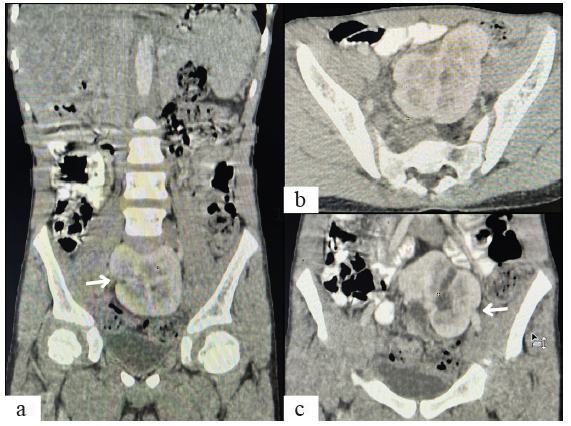 (a-b) Computed Tomography (CT) urography images showing (white arrow in a) the complete medial fusion of the renal parenchyma, located ectopically in the pelvic cavity at the midline. (c) CT urography image (white arrow) showing a single megaureter originating from the left side of the fused renal mass.