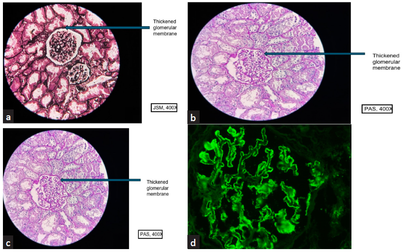 (a and b) show thickening and stiffening of the glomerular capillary loop (400x, PAS and 400x JSM). (c) shows in addition to the thickened loops, there were pockets of lymphomononuclear inflammatory cell infiltrate in the cortical parenchyma and chronic mild inflammation (400x, PAS). (d) Direct immunofluorescence showed coarse granular deposits for anti sera specific against IgG (3+), Kappa (3+), Lambda (3+), C3 (1+) in the sub epithelial aspect of glomerular capillary loop. Rest of the panel IgA, IgM, C1q was negative, PAS: periodic acid schiff.