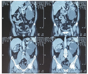 Contrast-enhanced computed tomography scan showing bilateral asymmetrical polycystic kidneys.