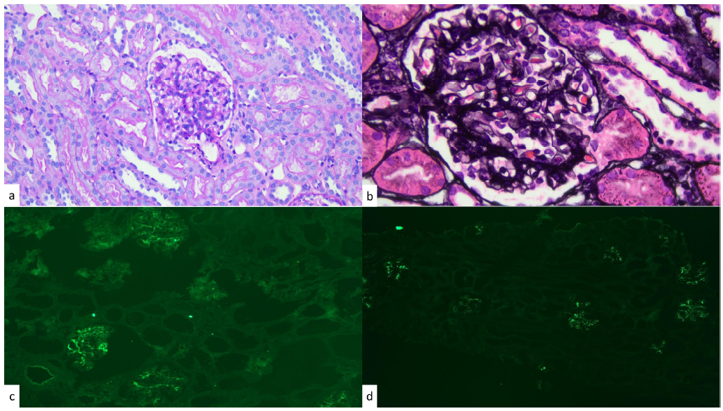 Histology and immunofluorescence. (a) Photomicrograph showing increased mesangial cellularity and normal endocapillary cellularity (PAS staining, 20x). (b) Photomicrograph showing a slight increase in mesangial reticular texture without true segmental sclerosis (PASM staining, 40x). (c) Positive immunofluorescence for IgA (10x). (d) Positive immunofluorescence for C1q (10x). PASM: Periodic Schiff-Methenamine Silver; PAS: Periodic acid-Schiff