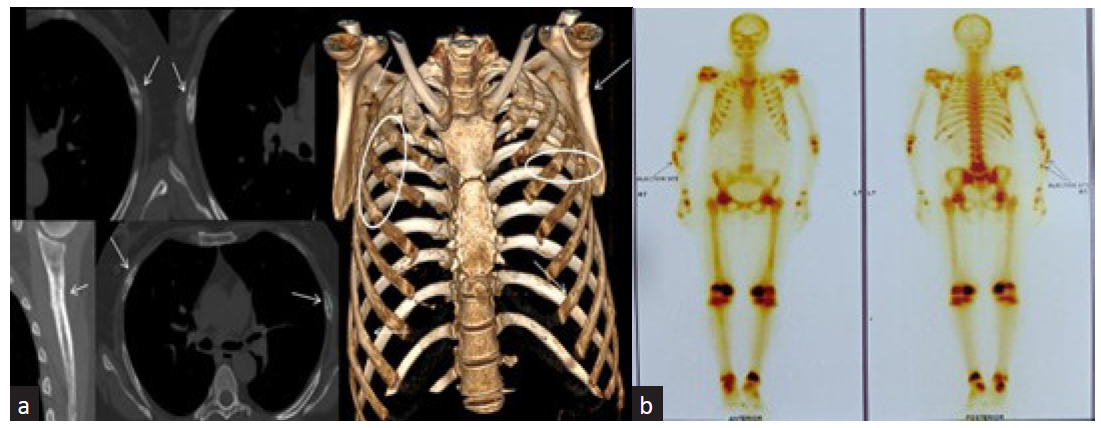 (a) Computed tomography thorax imaging and 3D reconstruction showing pseudofractures or Milkman’s fractures of multiple ribs bilaterally and medial borders of both scapulae are shown by the white arrows and white circles respectively. (b) Tc 99 bone scan showing increased uptake in the same areas.