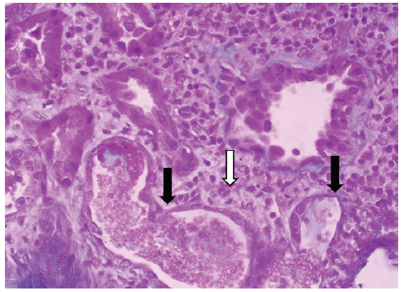 Kidney biopsy specimen with PAS stain from the patient with serum creatinine of 2.48 mg/dL. Desquamation of epithelial cells within the tubular lumen, thinning of the tubular epithelium (black arrows) with the presence of a peritubular inflammatory infiltrate (white arrow) (× 400). PAS: Periodic acid-Schiff.