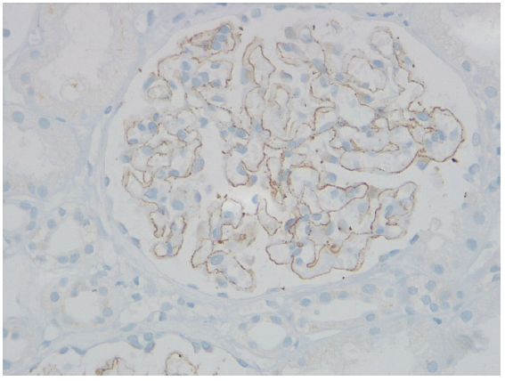 Neural Epidermal Growth Factor like 1 (NELL1) positivity on immunohistochemistry (IHC).