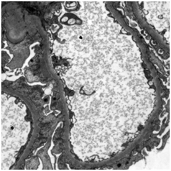 Electron microscopy showing subepithelial deposits.