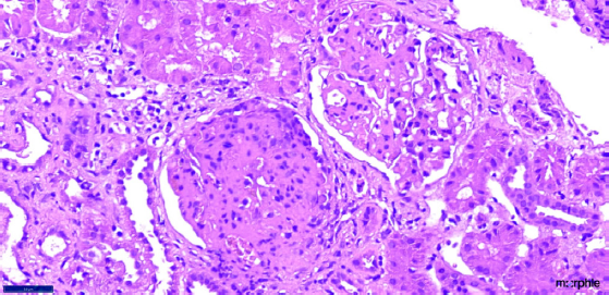 Renal biopsy (40× magnification in H and E staining) depicting two glomeruli; the upper glomerulus is showing segmental sclerosis (9 to 12 o clock position) while the lower glomerulus is showing pseudocrescent with collapse of the glomerular tuft.