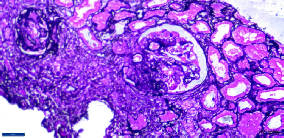 Renal biopsy (40× magnification in silver stain) showing two glomeruli; the one on the right side of the field is showing segmental sclerosis from 6 to 9 o clock position with podocyte hyperplasia and collapsed glomerular tuft.