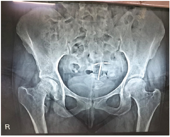 X ray imaging of the pelvis with bilateral hip joint showing fracture in the right neck of the femur.