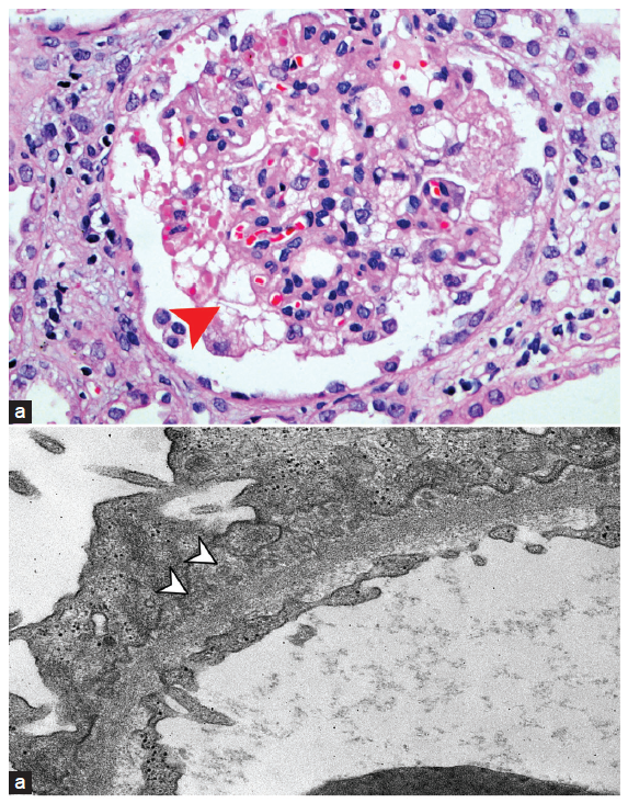 (a) Photomicrograph showing collapse of a glomerular capillary tuft with hyperplasia of overlying visceral epithelial cells, which exhibit prominent cytoplasmic eosinophilic droplets (red arrowhead) (H & E × 200). (b) Transmission electron micrograph showing subepithelial deposits composed of aggregates of spherular microparticles (white arrow heads) (×8000).