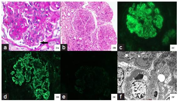 Histopathology of proliferative glomerulonephritis with monoclonal immunoglobulin deposits. (a) Glomerulus with marked mesangial expansion, mesangial hypercellularity, segmental endocapillary hypercellularity and segments of irregular capillary wall thickening with reduplication (bold black arrow) (Periodic acid schiff stain; original magnification X 400). (b) Three glomeruli with circumferential cellular crescents with underlying glomerular capillary tuft showing global endocapillary hypercellularity with lobular accentuation. Adjacent interstitium shows edema with severe acute tubular injury. (Hematoxylin and eosin stain; original magnification X 100). (c-e) Immunofluorescence microscopy displaying global, granular capillary wall, along with mesangial staining for IgG (4+ intensity) (c) and kappa light chain (4+ intensity) (d). There is no staining for lambda light chain (e). (original magnification X 400). (f) Ultrastructural examination displaying abundant large subendothelial electron dense immune complex type deposits along with concomitant mesangial deposits. Podocytes show global effacement. A diagnostic substructure is not evident. (Transmission electron microscopy, original magnification X 6000).