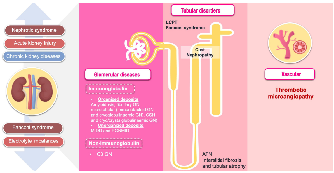 Spectrum of kidney involvement in multiple myeloma. ATN: Acute tubular necrosis, CSH: Crystal-storing histiocytosis, LCPT: Light chain proximal tubulopathy, GN: Glomerulonephritis, MIDD: Monoclonal immunoglobulin deposition diseases, PGNMID: Proliferative glomerulonephritis with monoclonal IgG deposits.