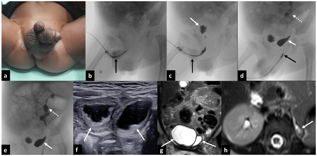 (a) Clinical photograph showing diphallia. (b-c) Retrograde urethrogram of the upper phallus reveals opacification of a distinct urethra (black arrows) and communication with one of the two separate urinary bladders (white arrow in c). (d-e) Retrograde urethrogram of the lower phallus shows opacification of the second distinct urethra (black arrow in d) and its communication with the second urinary bladder (white arrows in d and e). There is also contrast opacification of the dilated and tortuous left ureter and left pelvicalyceal system, indicative of vesicoureteral reflux (dotted arrows in d and e). (f) Gray-scale ultrasound showing duplicated urinary bladders (white arrows). (g-h) Magnetic resonance imaging confirming duplicated urinary bladders (white arrows in g) and a small left kidney (white arrow in h).