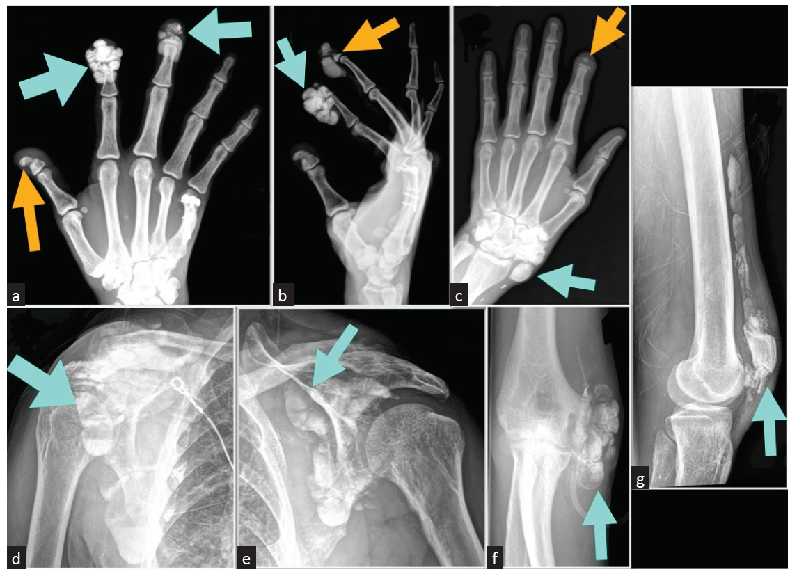 Plain radiograph showing calcified densities (blue arrows) in the (a and b) right index and middle fingers, (c) left wrist, (d and e) bilateral shoulders, (f) left elbow, and (g) left femur. Orange arrows represent acral osteolysis that affected the distal phalanx of (a) right thumb, (b) right long finger, and (c) left index finger.