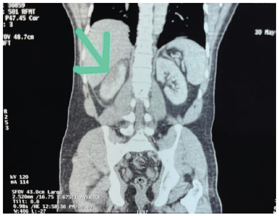 CT abdomen showing infarct in the right kidney. The green arrow marks the wedge-shaped hypodense lesion in the cortex of the upper pole of the right kidney. CT = computed tomography.