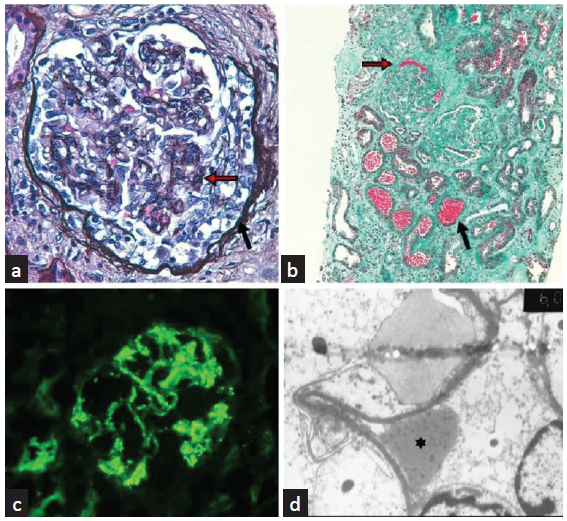 (a) Silver stain (magnification ×400), on light microscopy (LM): cellular crescent (black arrow) and endocapillary hypercellularity (red arrow); (b) Masson Trichrome stain (magnification ×100), on LM: extensive interstitial fibrosis and tubular atrophy, red blood cells’ casts (black arrow) and glomerular hemorrhage (red arrow); (c) Immunofluorescence: glomerular C3 granular deposition; (d) Electronic microscopy (magnification × 6000): subepithelial hump (*).