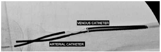 WavelinQ device used for the creation of a radial artery to the lateral radial vein fistula in the left forearm. The arterial electrode is at the bottom. The venous catheter, above the arterial electrode, contains the electrode that delivers a burst of radio frequency energy to create the AVF in the target zone. AVF: arteriovenous fistula. Courtesy: Dr Alejandro Alvarez