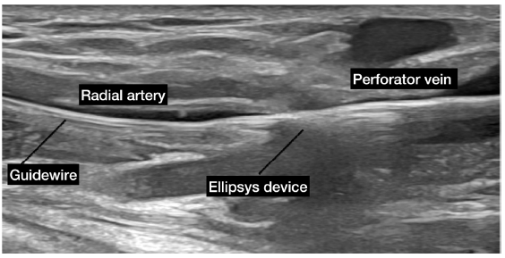 Ellipsys device used for the creation of a radial fistula. The ellipsys device passes from the perforator vein to the radial artery along a guide wire. The two ends of the Ellipsys catheter are approximated to deliver a burst of thermal energy to create the AVF in the target zone. AVF: arteriovenous fistula. Courtesy: Dr Naghae Mawla