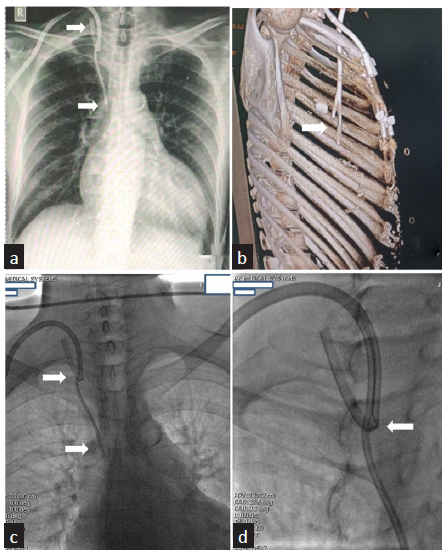 (a) Shows a chest x-ray with a malpositioned catheter, with one tip in the superior vena cava [SVC] and the other tip in the right IJV (white arrows). (b) Shows a CT reconstructed lateral image of the chest with a normally placed right-sided TCHC with both its tips in right atria (white arrow). (c) Shows a malpositionedTCHC with one tip in the right IJV and the other tip in SVC (white arrows). (d) White arrow shows a TCHC with one tip folded onto itself (white arrow).