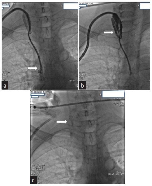 (a) Shows dye injected through the venous port of the TCHC exits from the tip in SVC without any filling defect (white arrow). (b) Shows dye injected via the arterial port exits from the misplaced tip in right IJV with filling defects (white arrow). (c) White arrow shows a remnant thrombus in the right IJV.