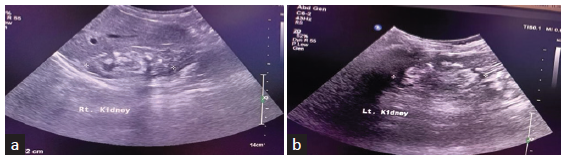 (a and b) Ultrasonographic images of both the kidneys of the index patient showing small-sized kidneys with bilateral nephrolithiasis.