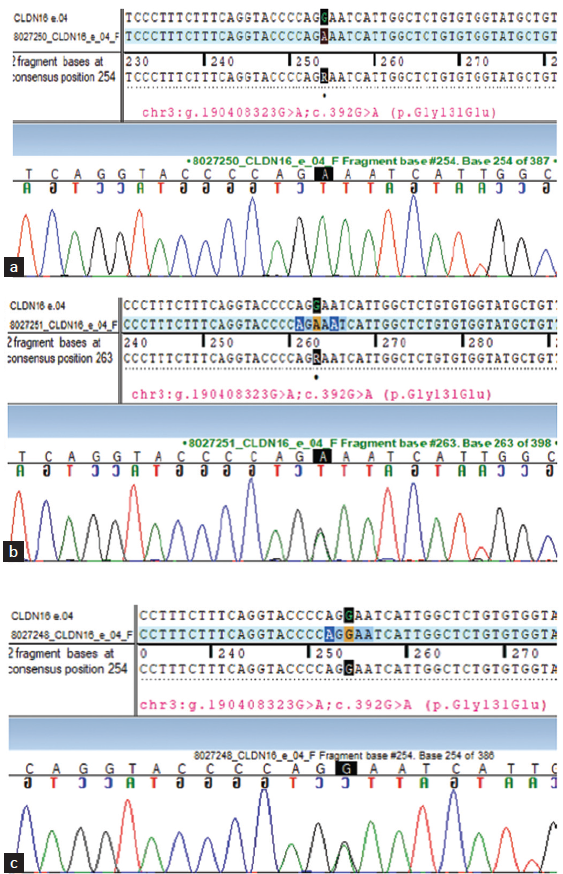 (a) Sanger sequencing of the younger sibling. (b) Sanger sequencing of the mother. (c) Sanger sequencing of the father. Colored lines indicate different nucleotides in the DNA sequence: red - Nucleotide T, green - Nucleotide A, blue - Nucleotide C, black - Nucleotide G