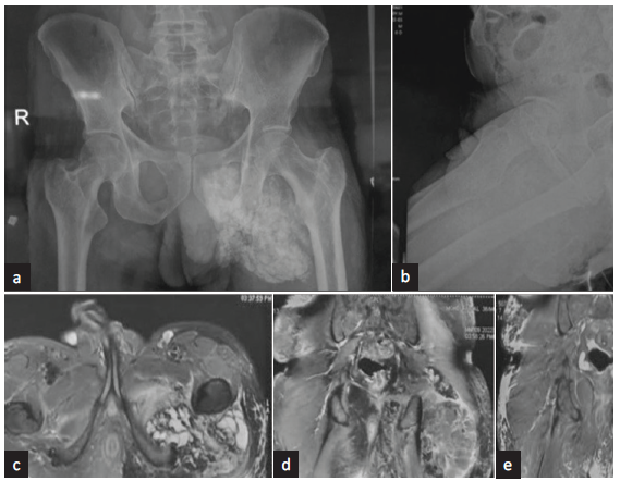 (a) X-ray pelvis anteroposterior and (b) lateral view depicting heterogenous fluffy opacity involving soft tissues of left side of inferior aspect of left hemi-pelvis and medial aspect of upper thigh, overlying ischial bones, extending up to left side hemi-scrotum. Magnetic resonance imaging (MRI) Pelvis with (c) contrast axial and (d) and (e) coronal view depicts large multilobulated septate cystic, partly solid soft tissue mass in proximal thigh & adjacent buttock surrounding posterior aspect of intertrochanteric and proximal shaft of femur. Septate cystic area was hypointense in T1, and hypo to hyperintense in T2 with multiple air fluid level showing dependent calcium. There was post-contrast patchy peripheral enhancement of the mass.
