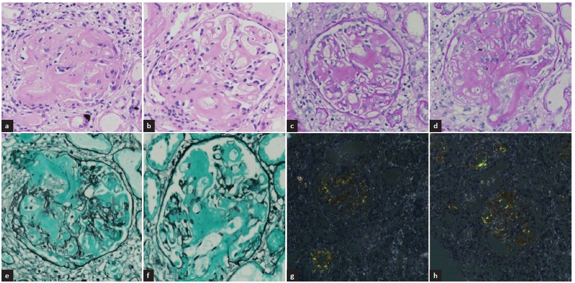 Kidney biopsy - light microscopy in 20X magnification- (a and b) Hematoxylin and Eosin staining show glomerulus with moderate mesangial matrix expansion due to deposition of amorphous extracellular material. (c and d) Periodic acid-schiff (PAS) staining depicts that amorphous extracellular material is PAS positive. (e and f) Silver methenamine staining depicts that the material is silver negative. (g and h) Congo red staining show congophilic deposits with apple-green birefringence under polarized microscope.