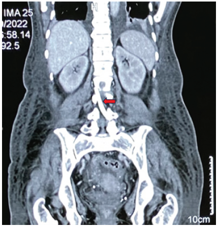 Computed Tomography (CT) abdomen coronal view. Red arrow marks hyperdense tubular structure (catheter) inside the spinal canal.