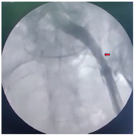 Fluoroscopic view of the left femoral vein after the catheter had been removed. Red arrow highlights no extravasation of contrast was seen outside the common iliac vein.