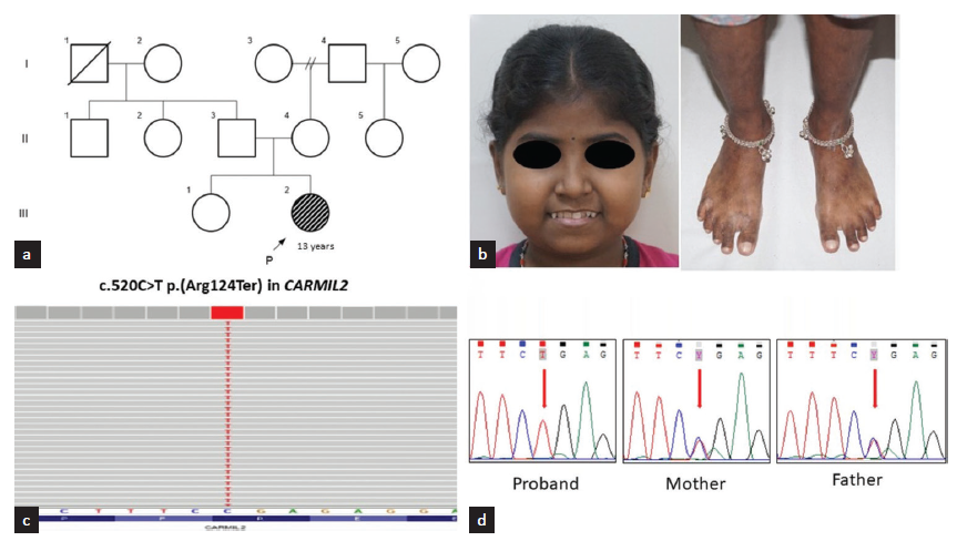 (a) Pedigree of the family; (b) Clinical photographs of the proband showing facial puffiness, hyperpigmented macules over the lower limbs (c) Integrated genomic viewer image showing sequence variant c.520C>T p.(Arg124Ter) in exon 7 of CARMIL2 in homozygous state; (d) Sanger chromatograms showing the same in homozygous state in the proband and heterozygous state in her parents.