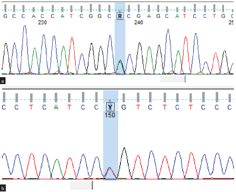 (a) Sanger sequencing data (electropherogram) shows a nucleotide change at c.1513G>A (p.Ala505Thr) in the KIRREL1 gene. (b) Sanger sequencing data (electropherogram) shows a nucleotide change at c.1918C>T (p.Arg640Cys) in the KIRREL1 gene.