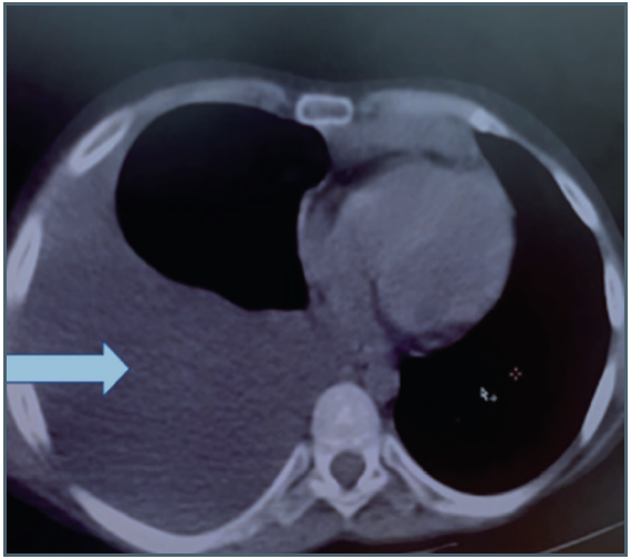 CT scan of thorax (axial view) showing unilateral right-sided pleural effusion (white arrowhead). CT = computed tomography.