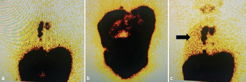 (a) Tc-99 sulfur colloid scintigraphy showing multiple static images of the abdomen and chest acquired immediately and at 1 and 4 h following intraperitoneal injection of 99m Tc sulfur colloid. (b) The image acquired 1 h after intraperitoneal injection shows the heterogeneous intraperitoneal distribution of the tracer in the abdomen. (c) There are also multiple foci of tracer activity in the thoracic region, which intensify at 4 h (marked by black arrowhead).