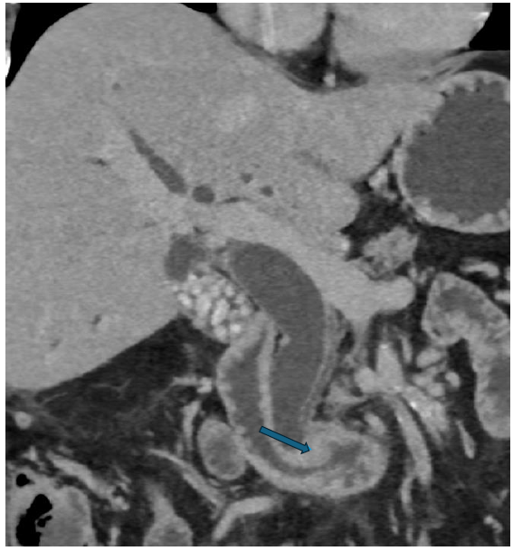 Contrast Enhanced-CT abdomen - Delayed phase - coronal section - showing enhancing polypoidal lesion in ampulla causing gross upstream dilatation of intra and extra hepatic biliary radicle dilatation (blue arrow).