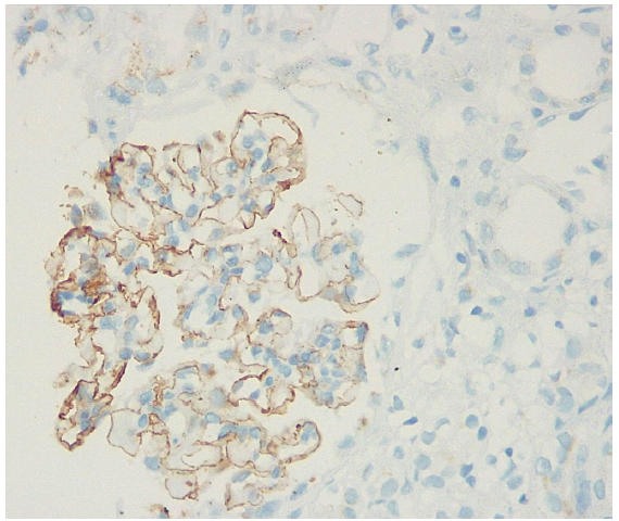 Immunohistochemistry showing diffuse NELL1 positivity (2+/3+) along the glomerular capillaries (NELL1 immunostain ×400) left hemithorax.