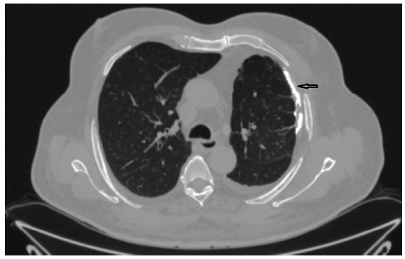 Black arrow indicates the calcified pleural plaques and loss of volume in left hemithorax.