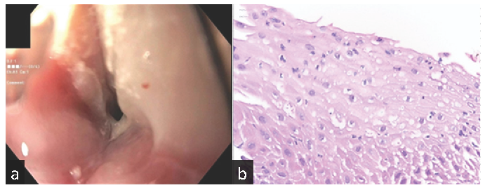 (a) Upper endoscopy showing benign intrinsic severe distal esophageal stricture, (b) Stricture biopsy showing focal acute inflammation. Hematoxylin and Eosin (H&E) stain x400.