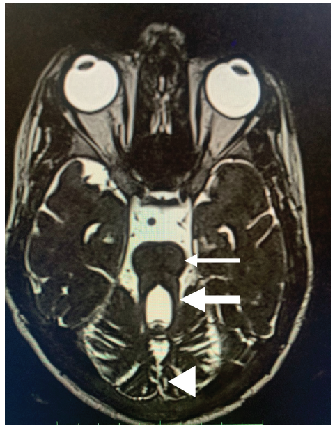 Magnetic resonance imaging (MRI) brain T2 weighted image, axial section. The thin white arrow shows the “Molar Tooth Sign.” The thick white arrow shows an elongated cerebellar peduncle. The white arrowhead shows cerebellar vermis hypoplasia.